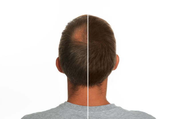 istock Man with hair loss problem before and after treatment on white background, collage. Visiting trichologist 1414764279