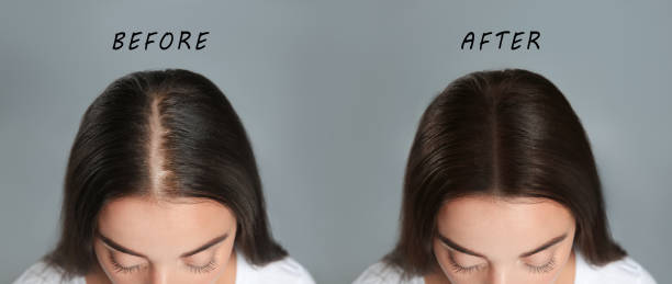灰色の背景、コラージュでの治療の前後に脱毛の問題を抱える女性�。トリコロジスト訪問 - 脱毛症 ストックフォトと画像