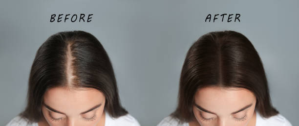 mulher com problema de queda de cabelo antes e depois do tratamento em fundo cinza, colagem. tricologista visitante - hair loss - fotografias e filmes do acervo