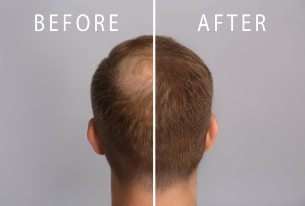 homme avec problème de perte de cheveux avant et après traitement sur fond gris, collage. trichologue visiteur - human scalp photos et images de collection