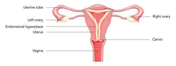 ilustrações, clipart, desenhos animados e ícones de hiperplasia endometrial útero do sistema reprodutivo feminino em diferentes estilos diagrama com inscrições texto visão frontal em um corte. anatomia humana órgãos internos doenças local esquema plano estilo ícone - endometrial adenocarcinoma