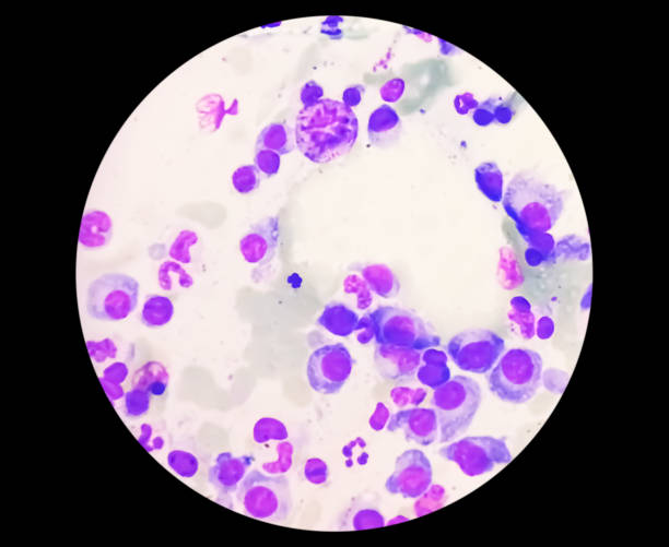 istock Microscopic view of bone marrow slide feature are suggestive Multiple myeloma, also known as myeloma, is a type of bone marrow cancer. 1415030077