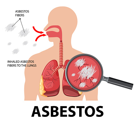 Diagram showing asbestosis in lungs illustration