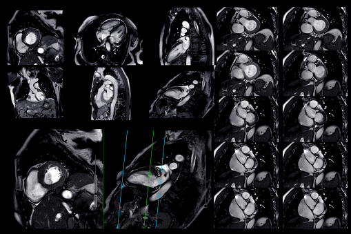 Collection of  MRI heart or Cardiac MRI ( magnetic resonance imaging ) of heart  showing heart beating for detecting heart disease.