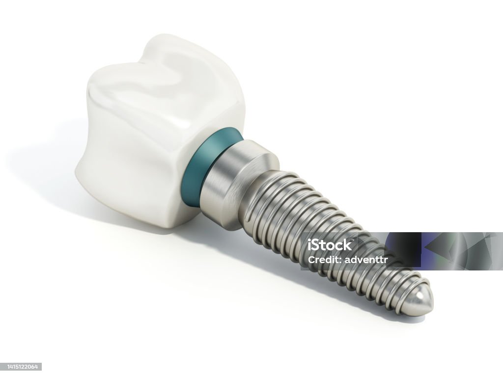 Titanium dental implant model isolated on white Titanium dental implant model isolated on white. Implant Stock Photo