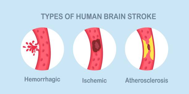 Types of human brain stroke. Ischemic, atherosclerosis and hemorrhagic stroke disease Types of human brain stroke. Ischemic, atherosclerosis and hemorrhagic stroke disease cerebrum stock illustrations