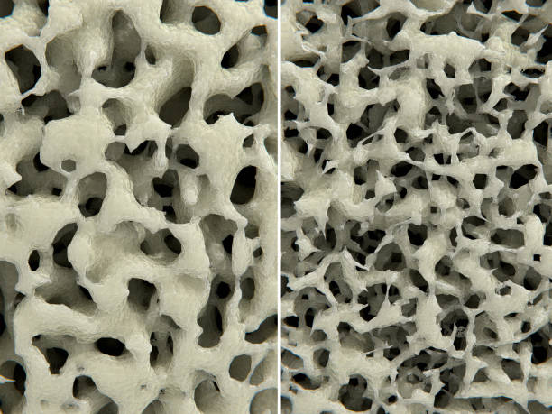 istock Osteoporosis,  healthy (left) and osteoporotic (right) bone tissue 1415205437