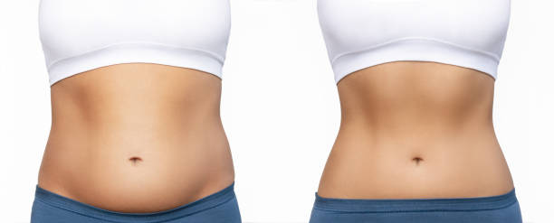 과도한 지방을 가진 여성의 잘린 샷과 체중 감량 전후에 복근으로 날씬한 위장을 톤 - dieting women slim muscular build 뉴스 사진 이미지