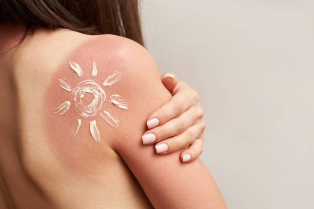 Sunburn on female shoulder, skin care and protection concept stock photo