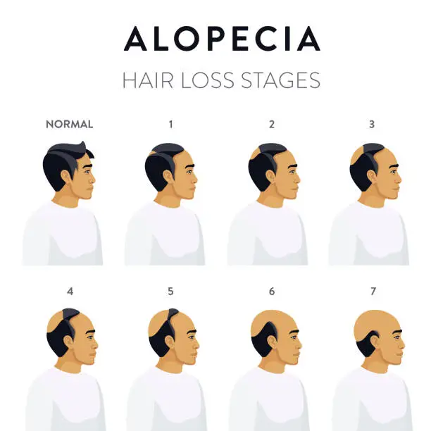 Vector illustration of Alopecia. Hair Loss Stages.