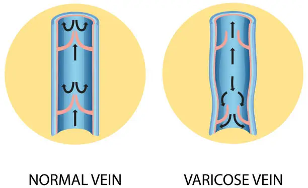 Vector illustration of A comparison of normal vein with varicose vein