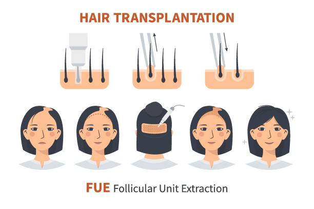 Stages of woman hair transplantation FUE Follicular Unit Extraction Stages of woman hair transplantation FUE Follicular Unit Extraction. Treatment of baldness, alopecia and hair loss. Vector medical infographics, a female head scalp. Strip, graft machine. thyroid disease stock illustrations