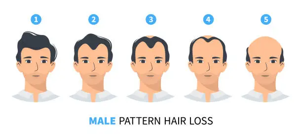 Vector illustration of Hair loss stages, androgenetic alopecia male pattern