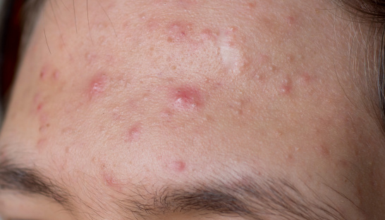 Male with acne on his forehead