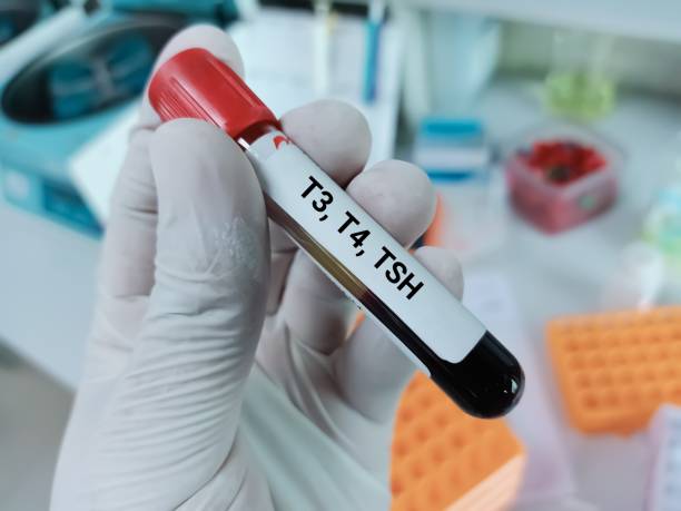 biochimico del medico detiene campione di sangue per t3, t4, tsh, test in background di laboratorio. - goiter foto e immagini stock