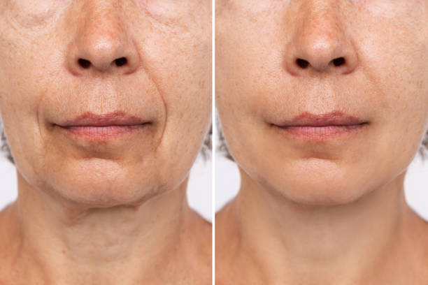 Lower part of face and neck of elderly woman with signs of skin aging before after plastic surgery Lower part of face and neck of an elderly woman with signs of skin aging before after facelift, plastic surgery. Age-related changes, flabby sagging skin, wrinkles, creases, puffiness. Rejuvenation fillers stock pictures, royalty-free photos & images