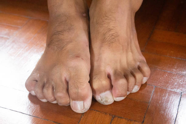 istock Characteristics of foot contraction in people with disabilities with foot problems 1415845188