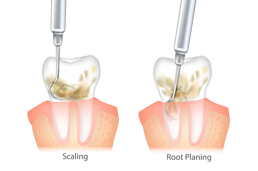 Difference of the Periodontal Scaling and Root Planing. Oral hygiene and conventional periodontal therapy. Human teeth cleaning treatment. Dental scale.