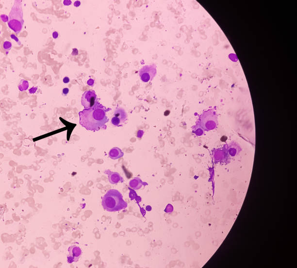 microscopic image of bone marrow. plasma cell dyscrasia or multiple myeloma. a type of bone marrow cancer of malignant plasma cells. - amyloid bildbanksfoton och bilder