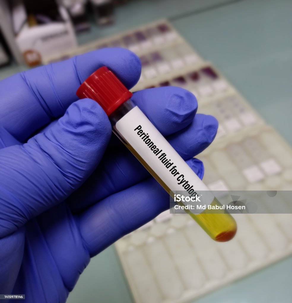 Medical technologist hold Peritoneal fluid for Cytology test, endometrioid carcinomas, Oncology. Abdomen Stock Photo
