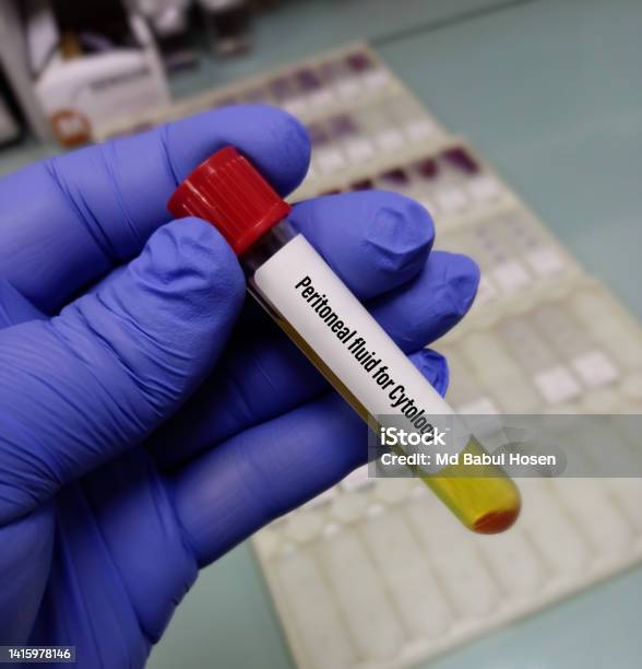 Medical Technologist Hold Peritoneal Fluid For Cytology Test Endometrioid Carcinomas Oncology Stock Photo - Download Image Now