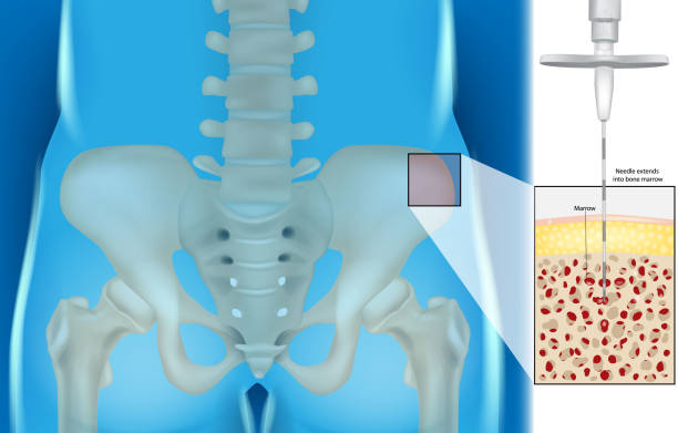 골수 흡인 및 생검. 바늘의 그림은 골수로 확장�됩니다. - leukemia pathologist blood hematologist stock illustrations