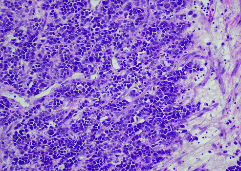 Invasive pleomorphic lobular carcinoma (PLC) of the breast is a subtype of invasive lobular cancer which compromises approximately 1% of all epithelial breast malignancies and is characterized by higher nuclear pleomorphism and poorer prognosis than classic invasive lobular cancer (ILC)
