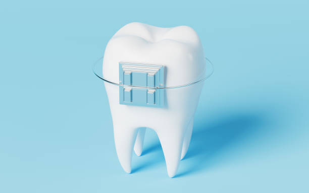 istock Tooth brace in the blue background, 3d rendering. 1416147179