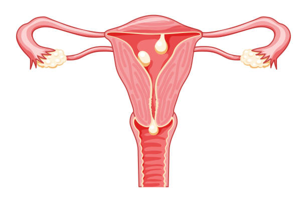 Polyps in the uterus - cervical, pedunculated and sessile Female reproductive system in cross sections. Front view in a cut. Human anatomy diseases internal organs location scheme flat style icon Polyps in the uterus - cervical, pedunculated and sessile Female reproductive system in cross sections. Front view in a cut. Human anatomy diseases internal organs location scheme flat style icon fallopian tube stock illustrations