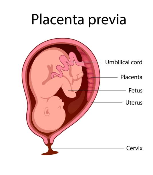 Placental previa Placental previa. Fetus in Uterus During Pregnancy. Women anatomy. Fetus with umbilical cord and placenta.
Usual anatomical Placenta Location. Detailed medical vector illustration. diagram of female reproductive system drawings stock illustrations