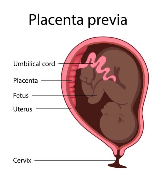 Placental previa Placental previa. Fetus in Uterus During Pregnancy. Women anatomy. Fetus with umbilical cord and placenta.
Usual anatomical Placenta Location. Detailed medical vector illustration. abdominal cavity stock illustrations