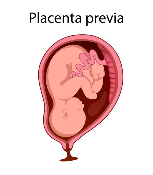 Placental previa Placental previa. Fetus in Uterus During Pregnancy. Women anatomy. Fetus with umbilical cord and placenta.
Usual anatomical Placenta Location. Detailed medical vector illustration. diagram of female reproductive system drawings stock illustrations
