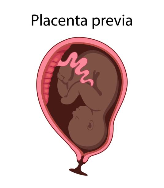 Different Placental Locations. Different Placental Locations. Fetus in Uterus During Pregnancy. Normal, top, low previa and front position.
Pathology. Detailed medical vector illustration. diagram of female reproductive system drawings stock illustrations