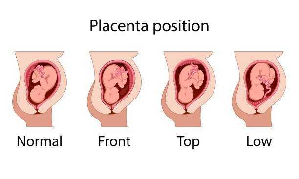 Different Placental Locations. Different Placental Locations. Fetus in Uterus During Pregnancy. Normal, top, low previa and front position.
Pathology. Detailed medical vector illustration. wombat stock illustrations