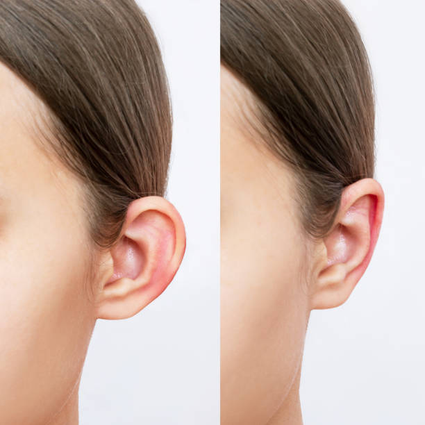 colpo ritagliato di testa di giovane donna con le orecchie prima e dopo l'otoplastica. risultato della correzione dei padiglioni auricolari - orecchie grandi foto e immagini stock