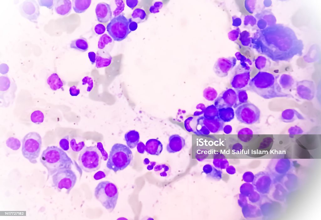 Microscopic view of bone marrow slide showing Multiple myeloma, also known as myeloma, is a type of bone marrow cancer. Multiple Myeloma Stock Photo