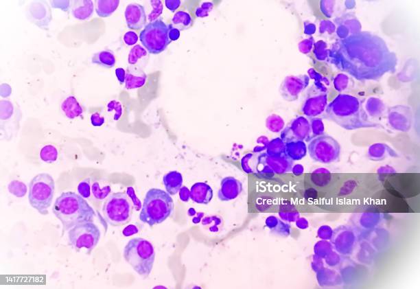 Microscopic View Of Bone Marrow Slide Showing Multiple Myeloma Also Known As Myeloma Is A Type Of Bone Marrow Cancer Stock Photo - Download Image Now