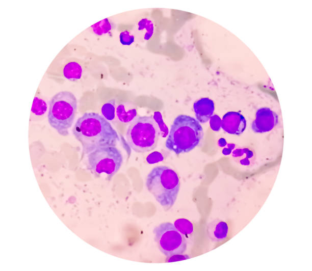 istock Microscopic view of bone marrow slide showing Multiple myeloma, also known as myeloma, is a type of bone marrow cancer. 1417727184