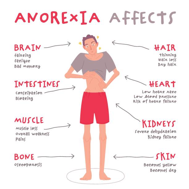 Eating disorder in men and boys. Anorexia nervosa. Eating disorder in men and boys. Anorexia nervosa. Medical infographic. Abnormal eating behavior that negatively affects physical or mental health. Vector illustration. Graphic design in flat style malnourished stock illustrations