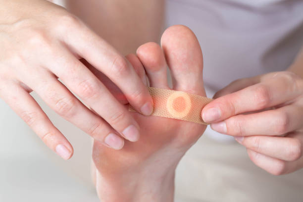 woman sticks a medical plaster to the plantar wart of the leg to remove dead skin and calluses, close-up - medicated imagens e fotografias de stock