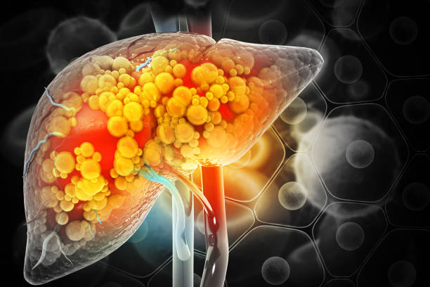 지방간, 섬유증, 간경변 및 간암과 같은 간 손상. 3d 일러스트레이션 - liver 뉴스 사진 이미지