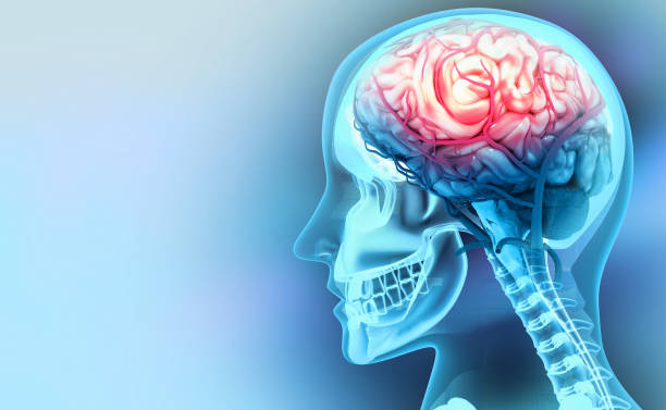 인간의 뇌 손상, 손상, 출혈. 3d 일러스트레이션 - 신경외과 뉴스 사진 이미지