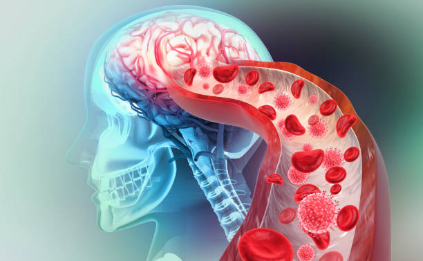 aterosclerosi ictus. un coagulo di sangue nei vasi del cervello umano. illustrazione 3d - 3119 foto e immagini stock