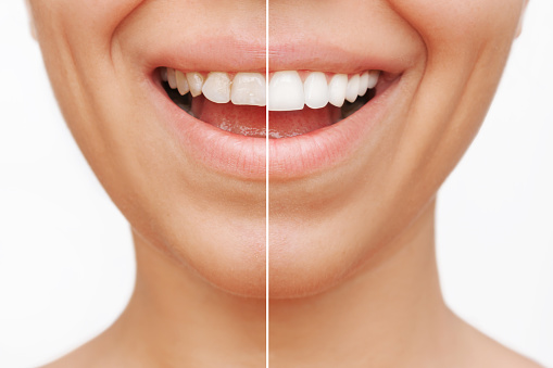 Cropped shot of a young caucasian smiling woman before and after veneers are installed isolated on a white background. Teeth whitening. Dentistry, dental treatment. The result of veneers installation