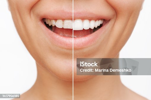 istock Cropped shot of a young caucasian smiling woman before and after veneers installation 1417956185