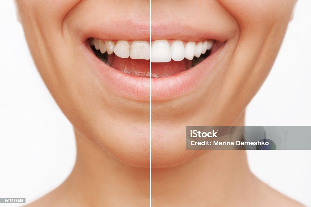 Cropped shot of a young caucasian smiling woman before and after veneers installation Cropped shot of a young caucasian smiling woman before and after veneers are installed isolated on a white background. Teeth whitening. Dentistry, dental treatment. The result of veneers installation Dental Veneers Stock Photo