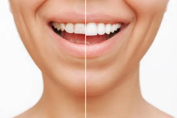 Photo of Cropped shot of a young caucasian smiling woman before and after veneers installation