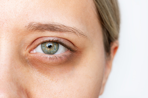 Cropped shot of a young caucasian woman's face with dark circle under eye isolated on a white background. Pale skin, bruises under eyes. Insomnia, stress