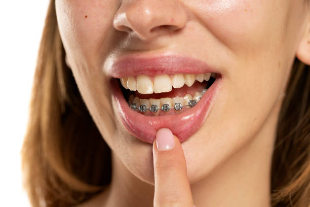 istock Woman showing her dentures on lower teeth. 1418224795