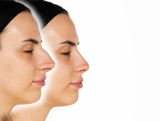 confronto del naso femminile, prima e dopo la chirurgia plastica - nose job foto e immagini stock